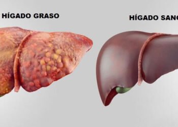 Enfermedad del hígado graso no alcohólico es epidemia mundial