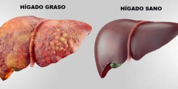 Enfermedad del hígado graso no alcohólico es epidemia mundial