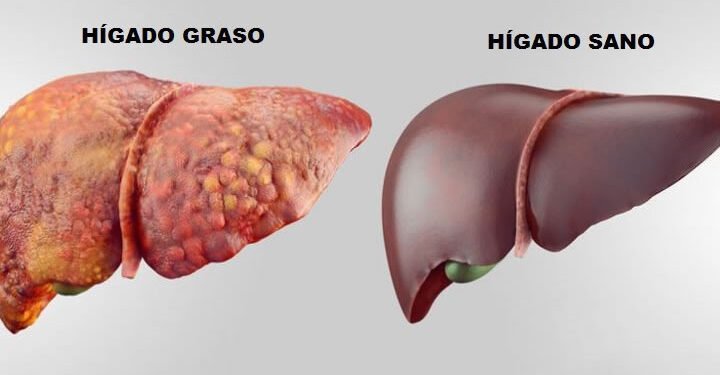 Enfermedad del hígado graso no alcohólico es epidemia mundial