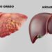 Enfermedad del hígado graso no alcohólico es epidemia mundial