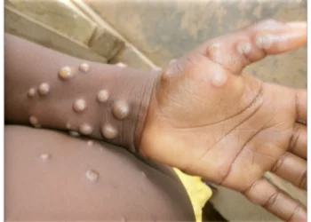 Salud Pública emite alerta epidemiológica preventiva por viruela del mono