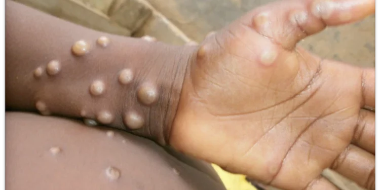 Salud Pública emite alerta epidemiológica preventiva por viruela del mono