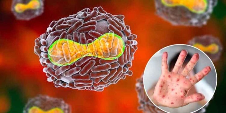 La viruela del mono es “poco probable” que se convierta en una pandemia, según OMS