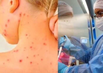 La OMS registra más de 3.400 casos de viruela del mono en 50 países desde inicios de este año