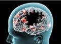 Se incrementa el Alzheimer dice Puello Herrera