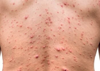 Para EEUU es «esencial» una acción coordinada contra la viruela del mono