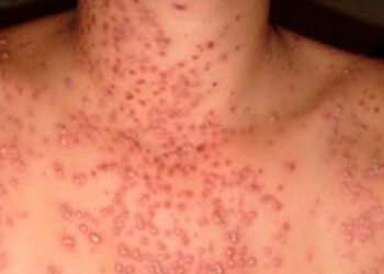 Salud Pública notifica un caso con síntomas de viruela del mono en la República Dominicana