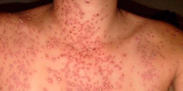 Salud Pública notifica un caso con síntomas de viruela del mono en la República Dominicana