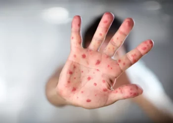 Epidemiólogos consideran necesario autoridades tomen medidas  para evitar propagación viruela del mono