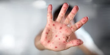 Epidemiólogos consideran necesario autoridades tomen medidas  para evitar propagación viruela del mono