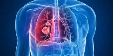 Casi la mitad de las muertes por cáncer en todo el mundo se deben a factores de riesgo prevenibles, sugiere un nuevo estudio