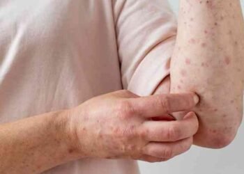 Salud Pública notifica cuarto caso de viruela símica en República Dominicana