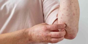 Salud Pública notifica cuarto caso de viruela símica en República Dominicana