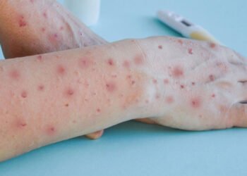 La OMS confirma más de 35.000 casos de viruela del mono en el mundo