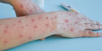 La OMS confirma más de 35.000 casos de viruela del mono en el mundo