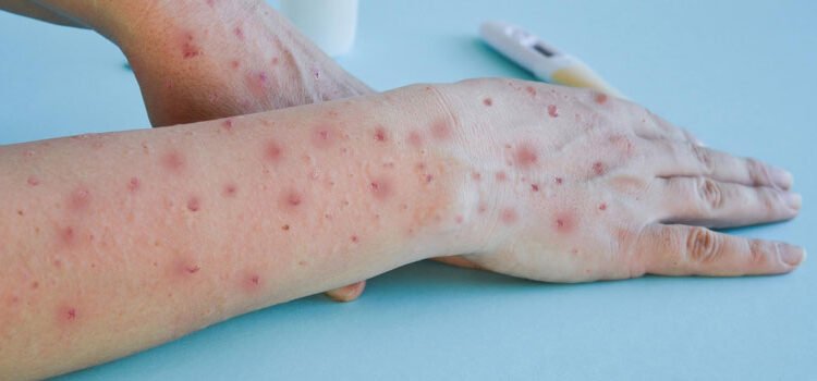 La OMS confirma más de 35.000 casos de viruela del mono en el mundo