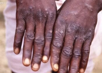 Orígenes de la viruela del mono, la nueva alerta sanitaria