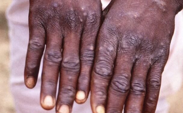 Orígenes de la viruela del mono, la nueva alerta sanitaria