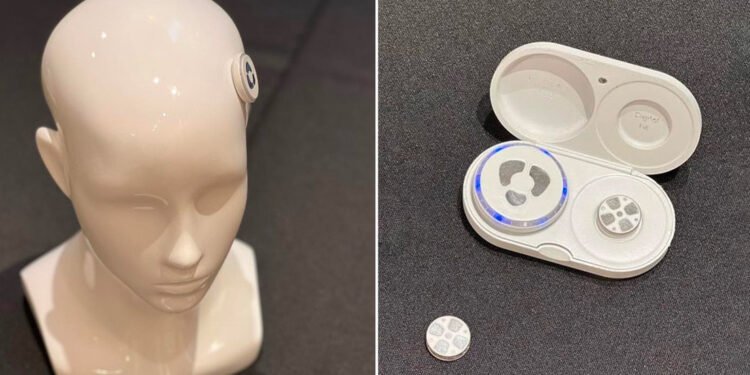 Presentan un innovador implante que «sin penetrar en el cerebro» promete curar la depresión