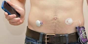 Prueban con éxito páncreas artificial paciente diabetes