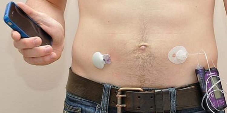 Prueban con éxito páncreas artificial paciente diabetes