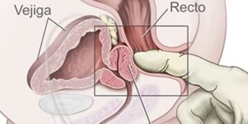 Adiós al tacto rectal para detectar el cáncer de próstata