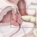 Adiós al tacto rectal para detectar el cáncer de próstata