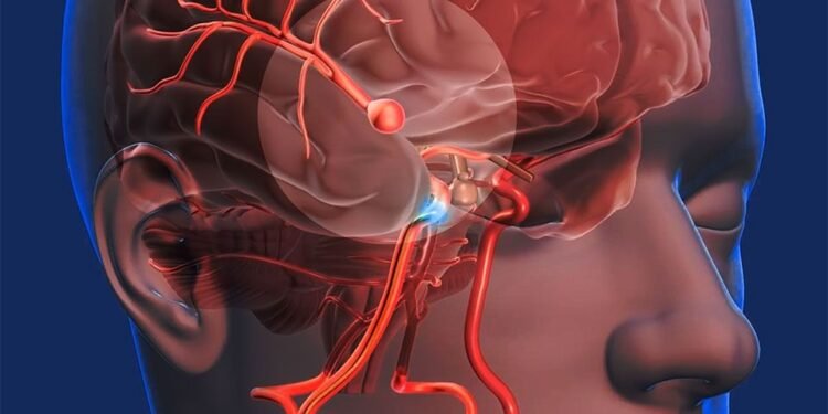 Los accidentes carebrovascular (ACV) son la principal causa de discapacidad de adultos en RD