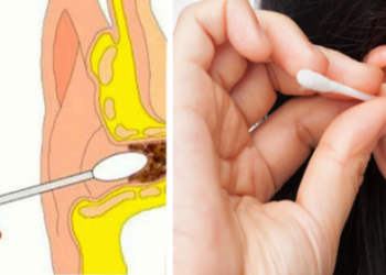 Hisopos: ¿Es correcto usarlo para limpiar los oídos?