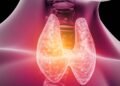 Advierten aumento de pacientes con cáncer de tiroides