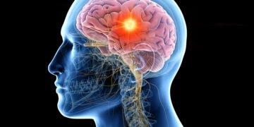 Experto advierte sobre el desafío del incremento de las metástasis cerebrales