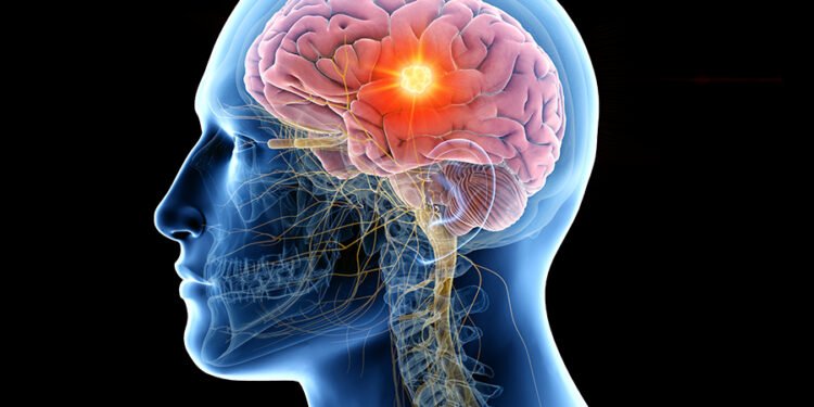 Experto advierte sobre el desafío del incremento de las metástasis cerebrales