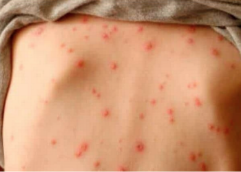 Salud Pública emite alerta epidemiológica por sarampión