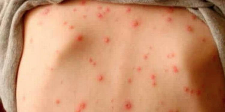 Salud Pública emite alerta epidemiológica por sarampión