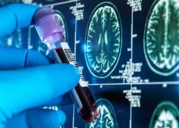 Un análisis de sangre permite diagnosticar el alzhéimer con una precisión del 95 %