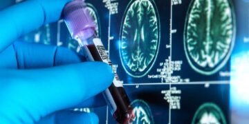 Un análisis de sangre permite diagnosticar el alzhéimer con una precisión del 95 %