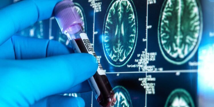 Un análisis de sangre permite diagnosticar el alzhéimer con una precisión del 95 %