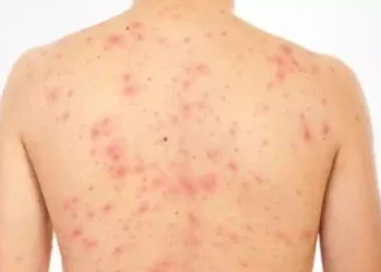 RD necesita que al menos el 99% de los niños que nacen o viven en en el país estén vacunados contra el sarampión