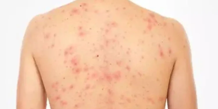 RD necesita que al menos el 99% de los niños que nacen o viven en en el país estén vacunados contra el sarampión