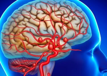 Advierten sobre factores de riesgo que pueden provocar un aneurisma cerebral