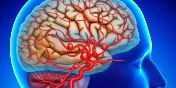 Advierten sobre factores de riesgo que pueden provocar un aneurisma cerebral