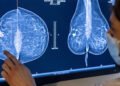 Los sujetadores del futuro detectarán el cáncer de mama