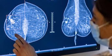 Los sujetadores del futuro detectarán el cáncer de mama