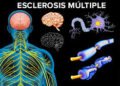 Especialistas observan alza de pacientes con esclerosis múltiple después del COVID-19