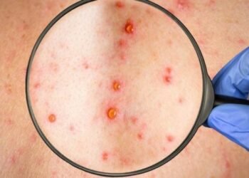 El país confirma seis casos de viruela símica y descarta 19 sospechosos en lo que va de año