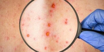 El país confirma seis casos de viruela símica y descarta 19 sospechosos en lo que va de año