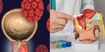 Cáncer de próstata: letalidad, prevención y tratamiento