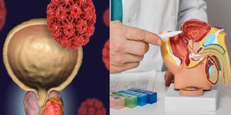 Cáncer de próstata: letalidad, prevención y tratamiento