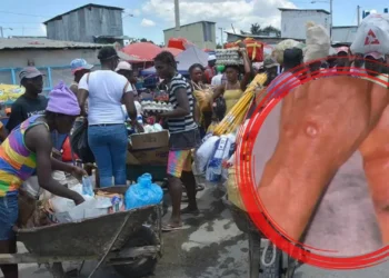 Haití detecta casos sospechosos ántrax; adopta rápidas medidas