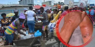 Haití detecta casos sospechosos ántrax; adopta rápidas medidas